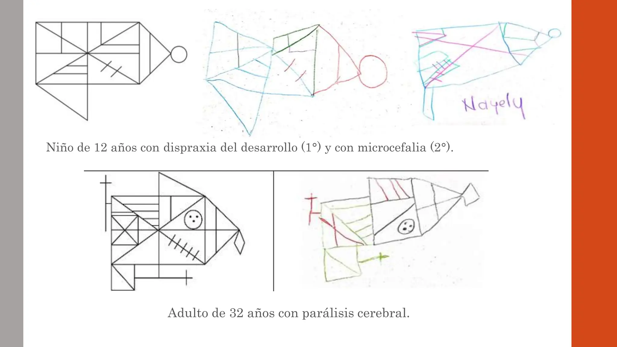 Niño de 12 años con dispraxia del desarrollo (1°) y con microcefalia (2°).
Adulto de 32 años con parálisis cerebral.
 