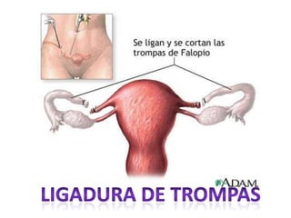 Ligadura de Trompas