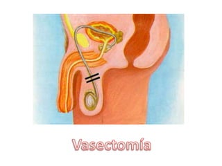 Vasectomía