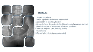 TECNICA:
1.Inspección pélvica
2.Rayos X previa a la inyección de contraste
3.Colocación de cánulas y tracción
4.Inyección lenta del contraste (2ml) Canal cervical y cavidad uterina)
5.Realizar 2da placa. Trompas en diferentes porciones
6.Realizar 3ra placa. ( AP, oblicua y lateral)
7.Vaciamiento
8.Control a los 15 min ( prueba de cotté)
 