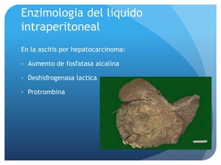 Enzimologia del liquido
intraperitoneal
En la ascitis por hepatocarcinoma:

- Aumento de fosfatasa alcalina
- Deshidrogenasa lactica
- Protrombina

 