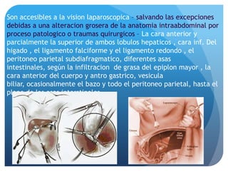 Son accesibles a la vision laparoscopica – salvando las excepciones
debidas a una alteracion grosera de la anatomia intraabdominal por
proceso patologico o traumas quirurgicos – La cara anterior y
parcialmente la superior de ambos lobulos hepaticos , cara inf. Del
higado , el ligamento falciforme y el ligamento redondo , el
peritoneo parietal subdiafragmatico, diferentes asas
intestinales, según la infiltracion de grasa del epiplon mayor , la
cara anterior del cuerpo y antro gastrico, vesicula
biliar, ocasionalmente el bazo y todo el peritoneo parietal, hasta el
plano de las asas interstinales.

 