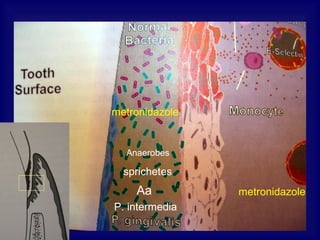•metronidazole
metronidazole
metronidazole
Aa
P. intermedia
sprichetes
Anaerobes
 