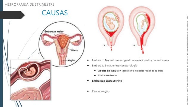 https://image.slidesharecdn.com/metrorragiadeitrimestre-161009183201/95/metrorragia-de-primer-trimestre-aborto-espontaneo-4-638.jpg?cb=1476039032
