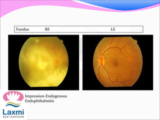 Fundus RE LE
Impression-Endogenous
Endophthalmitis
 