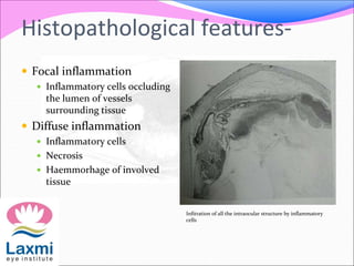 Histopathological features-
 Focal inflammation
 Inflammatory cells occluding
the lumen of vessels
surrounding tissue
 Diffuse inflammation
 Inflammatory cells
 Necrosis
 Haemmorhage of involved
tissue
Infitration of all the intraocular structure by inflammatory
cells
 