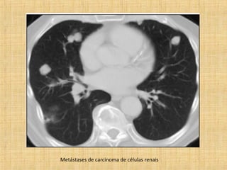 Metástases de carcinoma de células renais
 