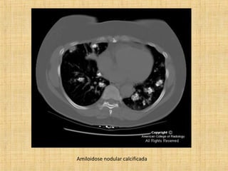 Amiloidose nodular calcificada
 
