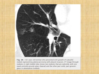 Metástases pulmonares final