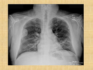 Metástases pulmonares final