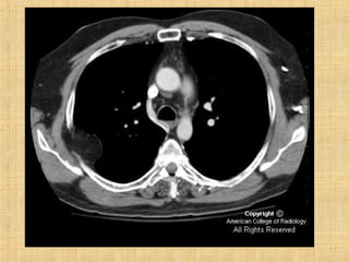 Metástases pulmonares final