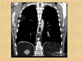 Metástases pulmonares final
