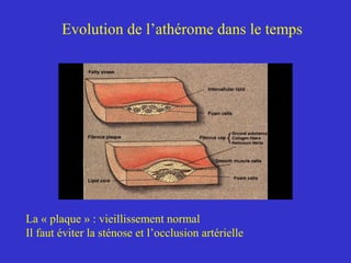 Evolution de l’athérome dans le temps 
La « plaque » : vieillissement normal 
Il faut éviter la sténose et l’occlusion artérielle 
 