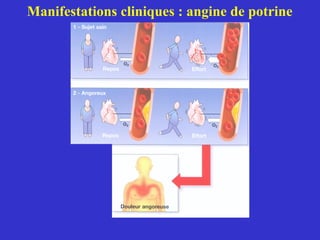 Manifestations cliniques : angine de potrine 
 