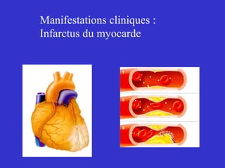 Manifestations cliniques : 
Infarctus du myocarde 
 
