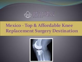 Mexico - Top & Affordable Knee
Replacement Surgery Destination
 