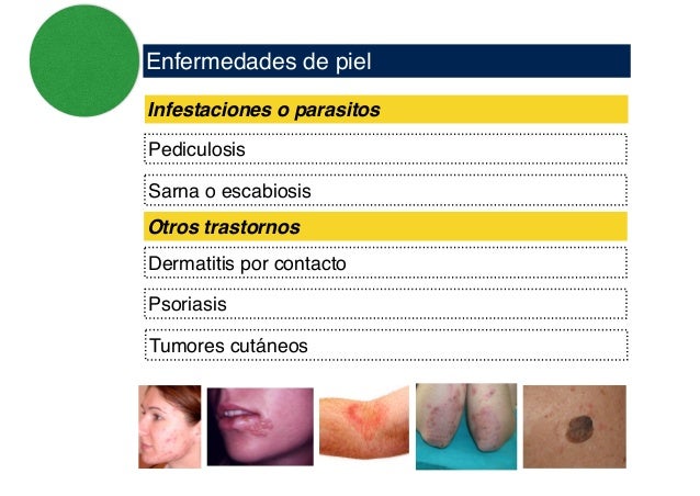 Vivo con la psoriasis