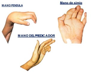 MANO PENDULA
Mano de simio
MANO DELPREDICADOR
 