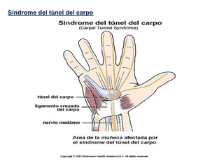 Síndrome del túnel del carpo
 
