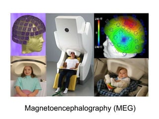 Magnetoencephalography (MEG)
 