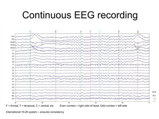Continuous EEG recording
F = frontal, T = temporal, C = central, etc Even number = right side of head, Odd number = left side
International 10-20 system – ensures consistency
 