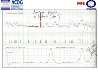 • Son incrementos visuales de la FCF por encima de la
frecuencia de la línea de base que duran < 30
segundos desde su inicio hasta su pico.
• Aceleraciones con picos > 15 LPM y duración de >15
segundos.
• En embarazos < 32 semanas, aceleraciones con picos
> 10 LPM y duración > 10 segundos.
Aceleraciones
 