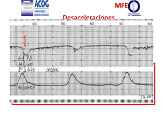 Desaceleraciones
Son imagen en espejo con la contracción
uterina, es decir el acmé de la contracción
coincide con el vértice de la desaceleración y la
recuperación es simultánea con el término de
la contracción
Son un descenso brusco de la FCF
por debajo de la línea de base
 