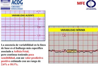 La ausencia de variabilidad en la línea
de base es el hallazgo más específico
asociado a Asfixia Fetal,
pero continua teniendo poca
sensibilidad, con un valor predictivo
positivo estimado con un rango de
2.6% a 18.1%.
 