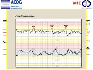 Aceleración
Prolongada, dura
mas de 2 minutos
 
