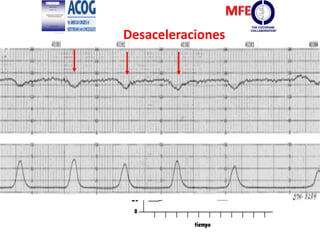 Desaceleraciones
Tempranas
Desaceleración
temprana.
Imagen en espejo
 