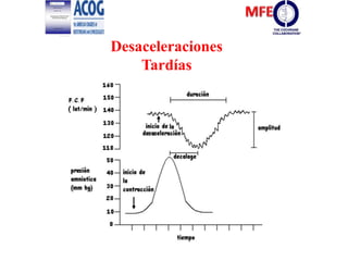 Desaceleraciones
Tardías
 