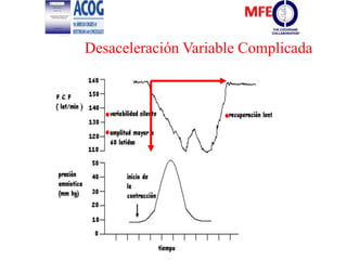 Desaceleración Variable Complicada
 