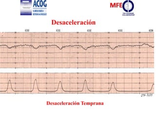 Desaceleración
Desaceleración Temprana
 