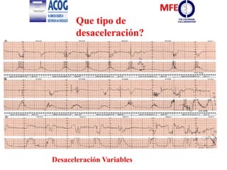 Que tipo de
desaceleración?
Desaceleración Variables
 