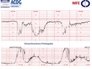 Desaceleraciones Prolongadas
 
