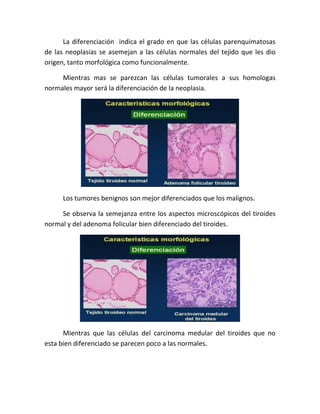 La diferenciación indica el grado en que las células parenquimatosas
de las neoplasias se asemejan a las células normales del tejido que les dio
origen, tanto morfológica como funcionalmente.
Mientras mas se parezcan las células tumorales a sus homologas
normales mayor será la diferenciación de la neoplasia.

Los tumores benignos son mejor diferenciados que los malignos.
Se observa la semejanza entre los aspectos microscópicos del tiroides
normal y del adenoma folicular bien diferenciado del tiroides.

Mientras que las células del carcinoma medular del tiroides que no
esta bien diferenciado se parecen poco a las normales.

 