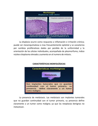 La displasia ocurre como respuesta a inflamación e irritación crónica;
puede ser mesenquimatosa o mas frecuentemente epitelial y se caracteriza
por cambios proliferativos dados por perdida de la uniformidad y la
orientación de las células individuales, acompañada de pleomorfismo, índice
núcleo-citoplasma elevado y aumento en el numero de mitosis.

CARACTERÍSTICAS MORFOLÓGICAS

La presencia de metástasis. Las metástasis son implantes tumorales
que no guardan continuidad con el tumor primario, su presencia define
claramente a un tumor como maligno; ya que las neoplasias benignas no
metastizan.

 