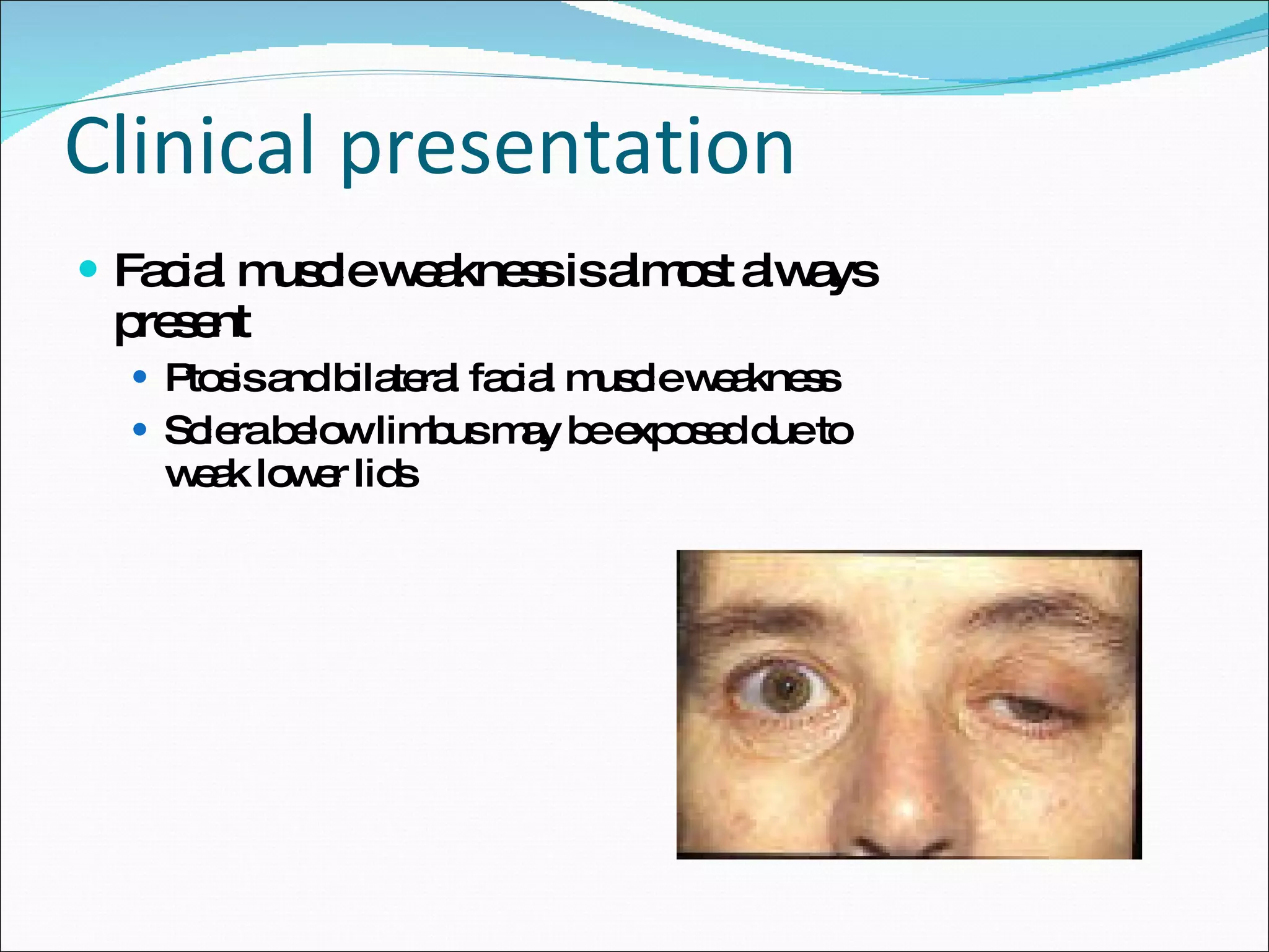 Clinical presentation Facial muscle weakness is almost always present Ptosis and bilateral facial muscle weakness Sclera below limbus may be exposed due to weak lower lids 
