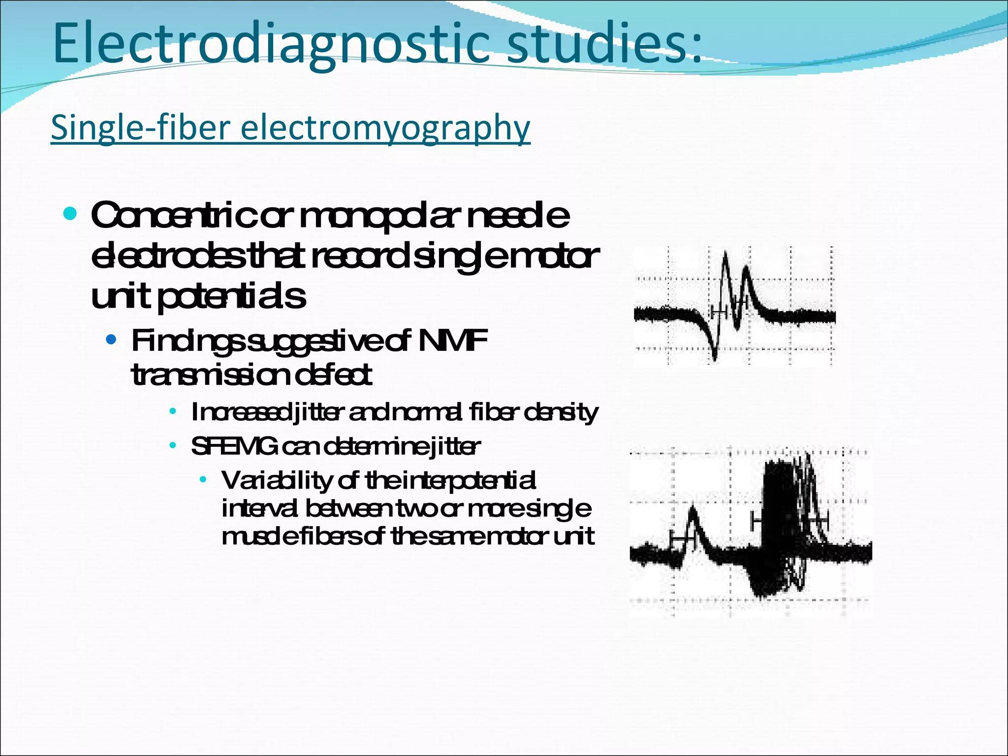 Electrodiagnostic studies: Single-fiber electromyography Concentric or monopolar needle electrodes that record single motor unit potentials Findings suggestive of NMF transmission defect Increased jitter and normal fiber density SFEMG can determine jitter Variability of the interpotential interval between two or more single muscle fibers of the same motor unit 