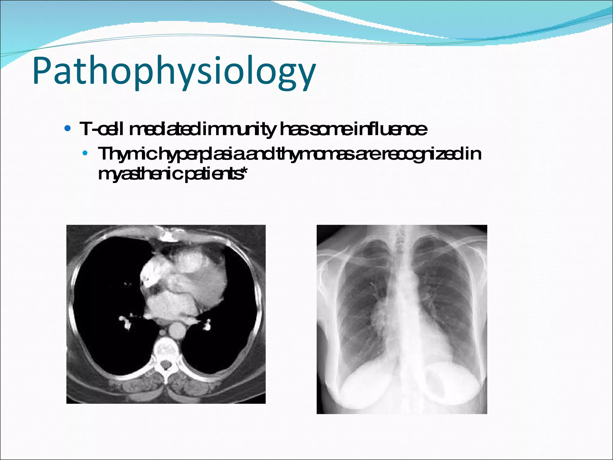 Pathophysiology T-cell mediated immunity has some influence Thymic hyperplasia and thymomas are recognized in myasthenic patients* 