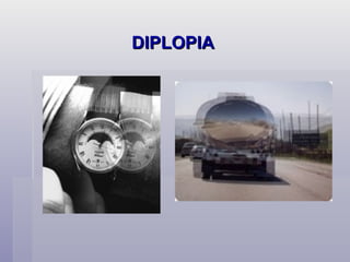 DIPLOPIA 