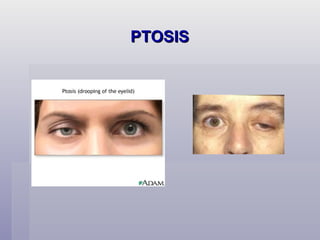 PTOSIS 