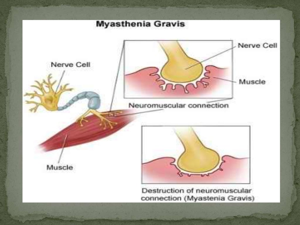Myasthenia gravis