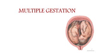 MULTIPLE GESTATION
 