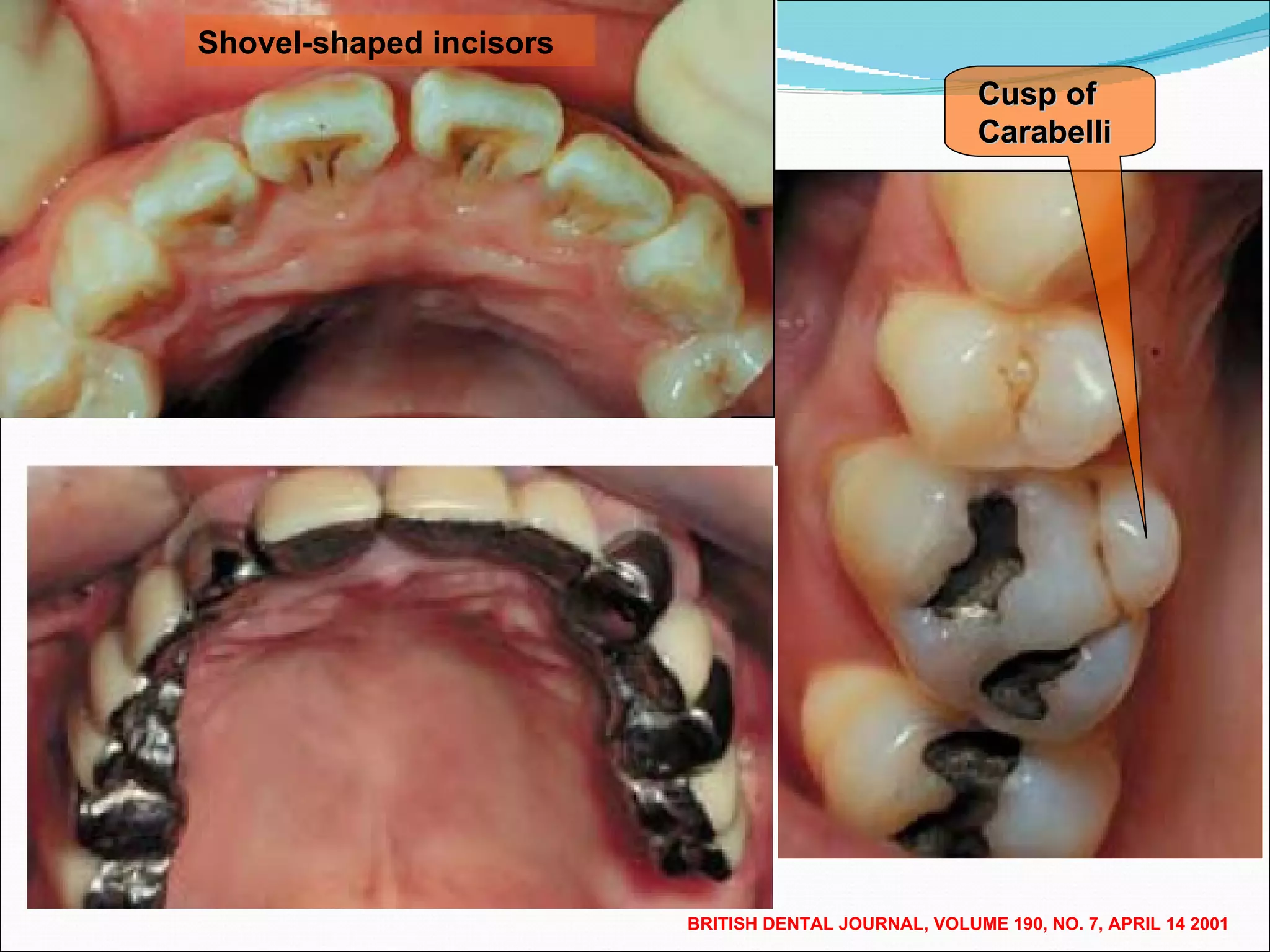 BRITISH DENTAL JOURNAL, VOLUME 190, NO. 7, APRIL 14 2001 Shovel-shaped incisors Cusp of Carabelli 