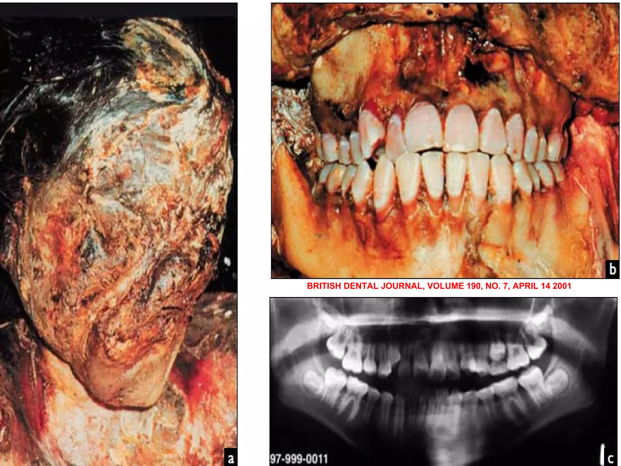 BRITISH DENTAL JOURNAL, VOLUME 190, NO. 7, APRIL 14 2001 