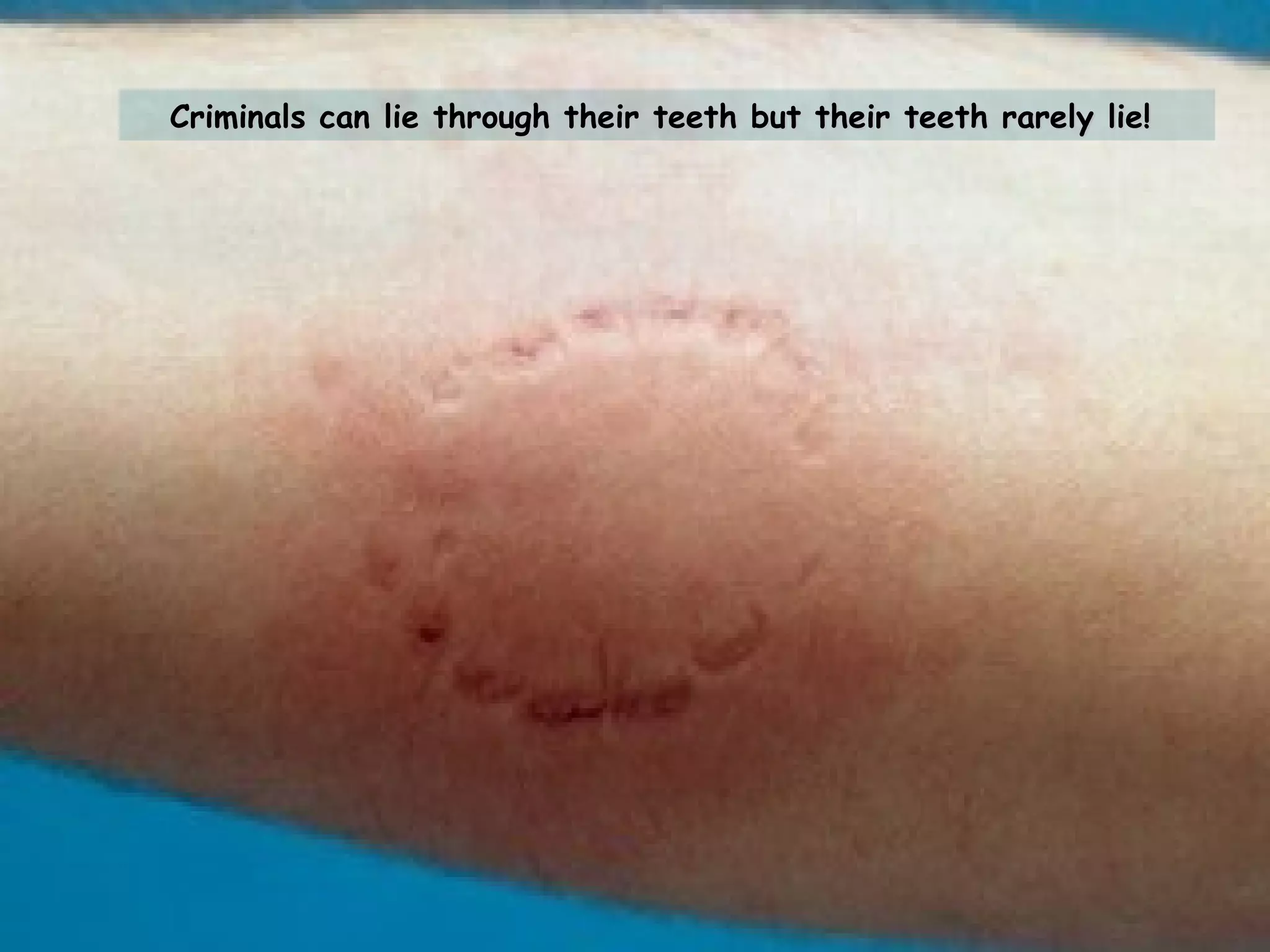 Criminals can lie through their teeth but their teeth rarely lie!  