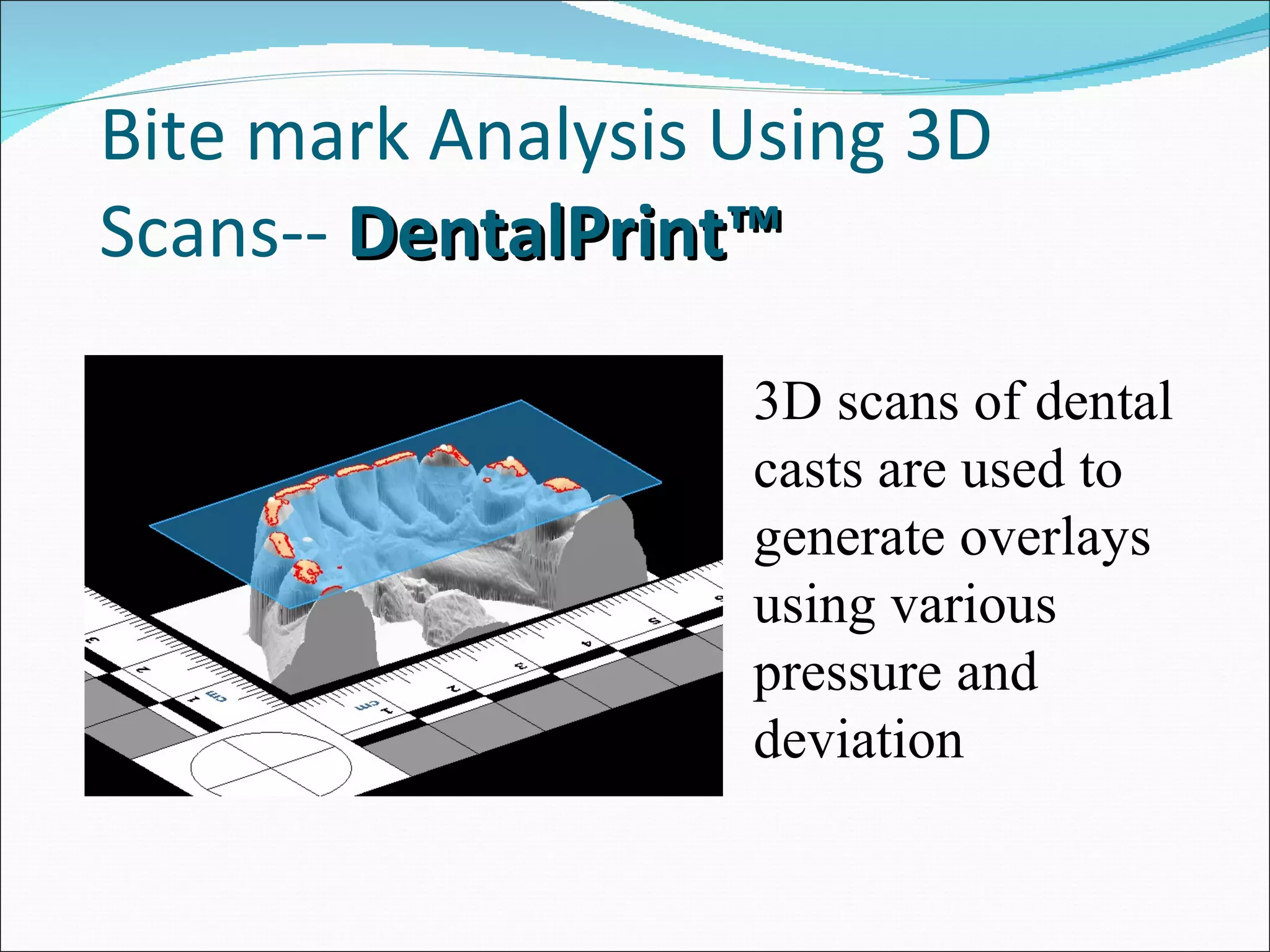 Bite mark Analysis Using 3D Scans--  DentalPrint™ 3D scans of dental casts are used to generate overlays using various pressure and deviation .  
