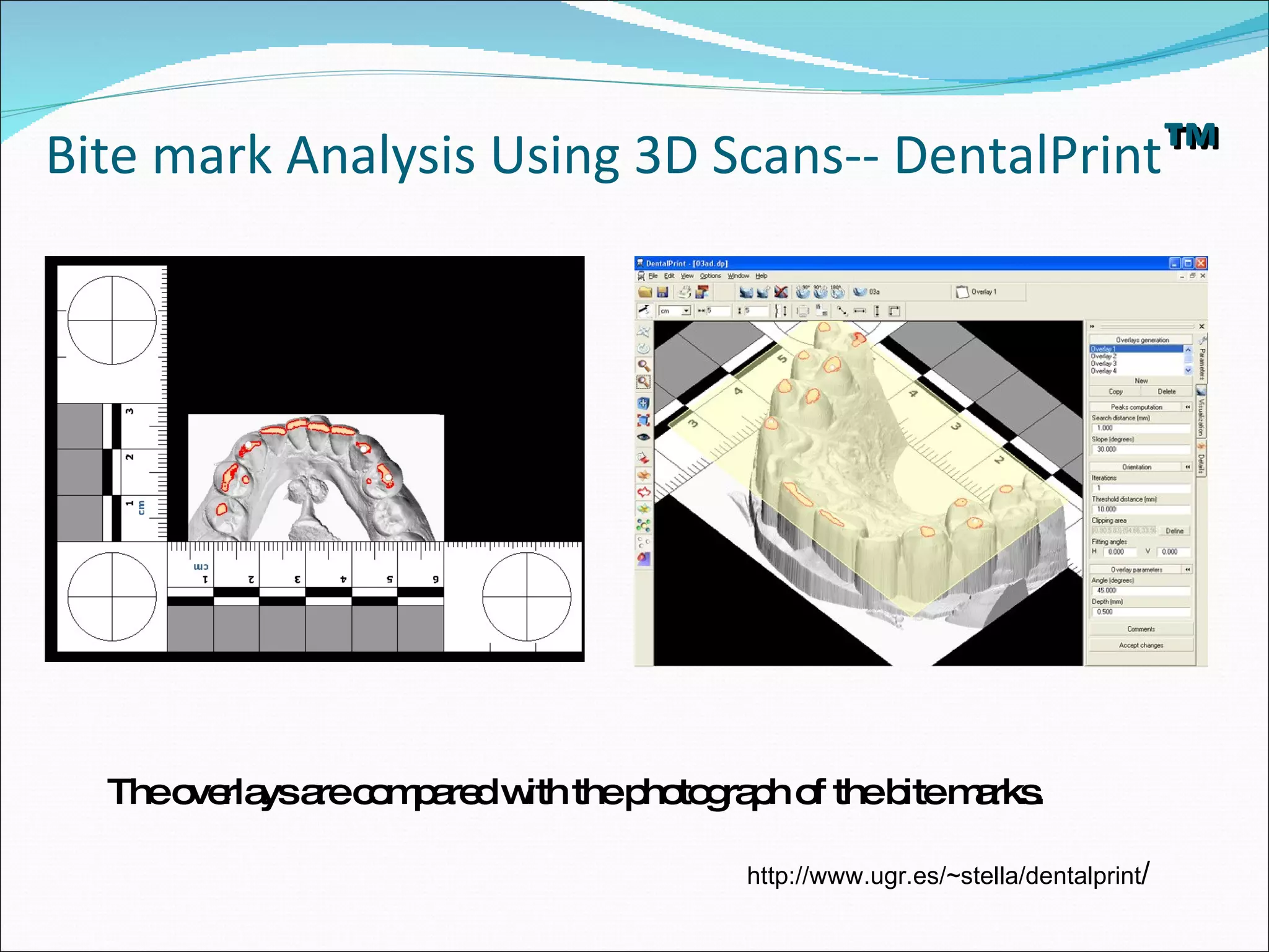 Bite mark Analysis Using 3D Scans-- DentalPrint ™ The overlays are compared with the photograph of the bite marks. http://www.ugr.es/~stella/dentalprint / 