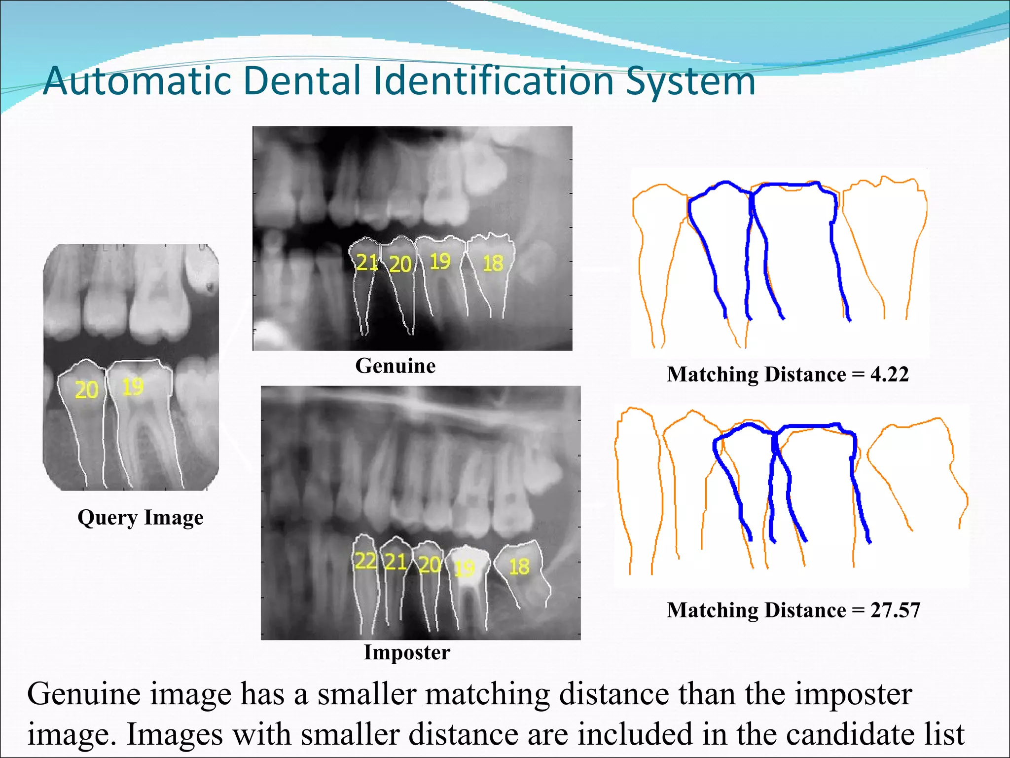 Automatic Dental Identification System Genuine image has a smaller matching distance than the imposter image. Images with smaller distance are included in the candidate list . Query Image Genuine Matching Distance = 4.22 Imposter Matching Distance = 27.57 